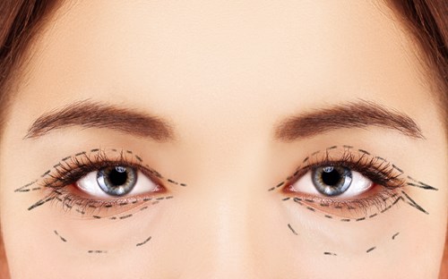 Is blepharoplasty surgery right for you? 