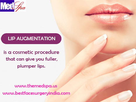 Lip Augmentation Surgery to Enlarge the Size of Lips by Injecting Fillers